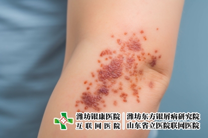 攝圖網_600370515_牛皮癬類型（企業商用）_副本
