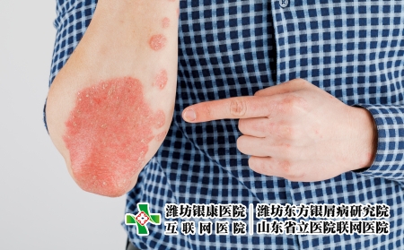 攝圖網_506432486_患有粗俗的牛皮癬濕疹和其他皮膚病（企業商用）