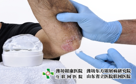 攝圖網_503148875_用手套保護雙手的皮膚科醫生用乳膏治療患有銀屑病的成年男（企業商用）