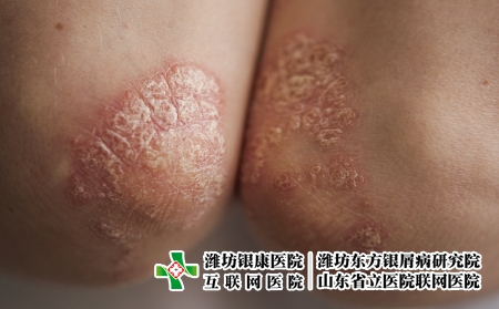 攝圖網_326238053_身穿白色T恤的年輕女子手肘皮膚上的絲蟲病癥狀發癢皮炎疾病衛生保健濕疹皮膚科女性女孩（企業商用）