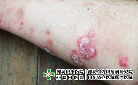 攝圖網(wǎng)_323551459_絲蟲病宏觀藥品疾病彎頭發(fā)癢病人醫(yī)療皮膚手臂皮炎（企業(yè)商用）