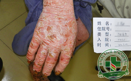 預(yù)防女性關(guān)節(jié)病型銀屑病方法