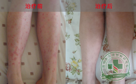 膿皰型銀屑病