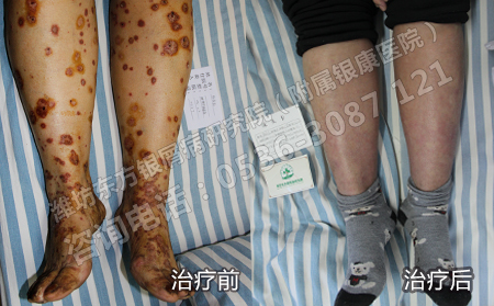 病情穩定后