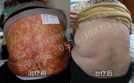 病情穩定后