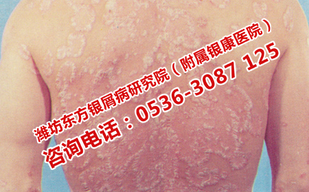 預防銀屑病的小妙招