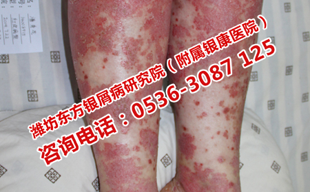 濰坊膿皰型牛皮癬應該去哪兒治療