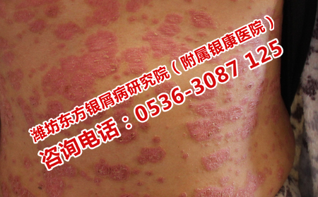 濰坊哪家醫院治療牛皮癬效果專業