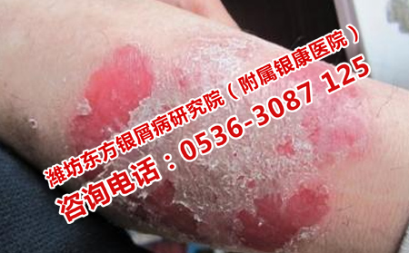 銀屑病恢復慢的原因