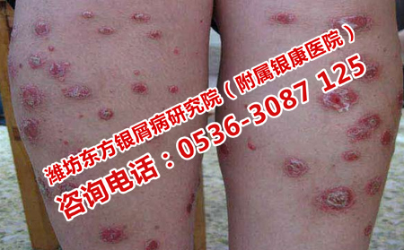 濰坊治療女性牛皮癬
