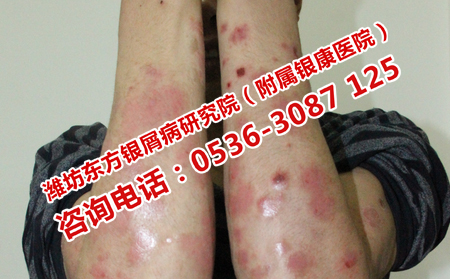 如何治療復(fù)發(fā)性牛皮癬