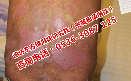 牛皮癬跟什么有關(guān)