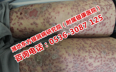 青少年牛皮癬患者吃點什么比較理想