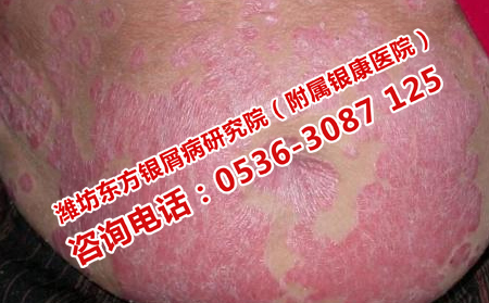 遠離牛皮癬的方法會什么