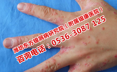 在校突發牛皮癬的原因是什么