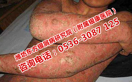 牛皮癬護理不理想有什么嚴重后果