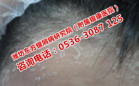 得了牛皮癬應該怎樣治療