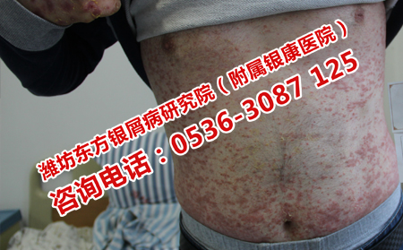 男性牛皮癬患者日常應(yīng)該注意什么