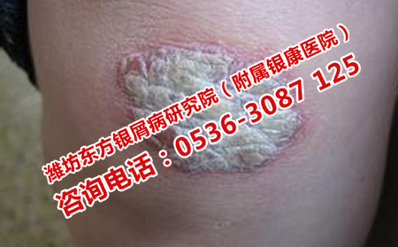 正規治療牛皮癬注意遵循哪些原則