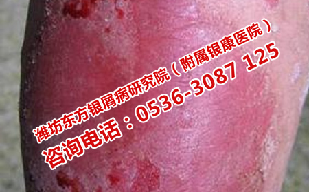 牛皮癬為什么不見理想轉