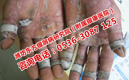 光照治療銀屑病有效嗎
