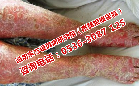 怎樣擺脫牛皮癬復發