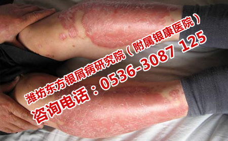 濰坊哪家醫院看銀屑病理想