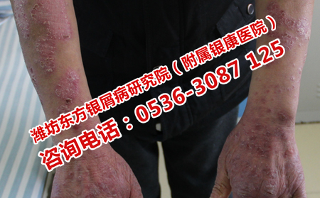 濰坊牛皮癬恢復(fù)的步驟