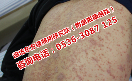 青州理想的牛皮癬醫生