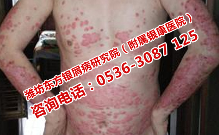 高密治銀屑病怎么樣
