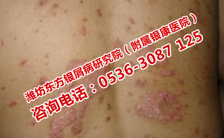 濰坊治療牛皮癬價格