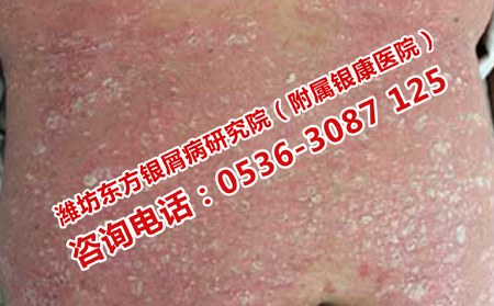 高密理想點的牛皮癬醫院