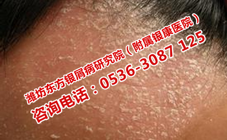 銀屑病的癥狀是什么