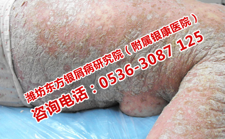 奎文治療銀屑病