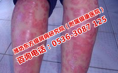 坊子牛皮癬治療