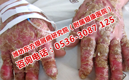 濰坊治銀屑病理想的醫(yī)院