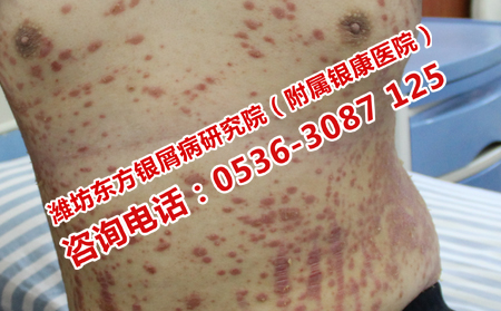 盡量去那家醫院治牛皮癬