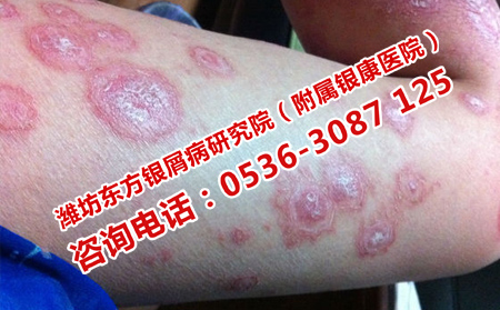 濰城區(qū)看銀屑病