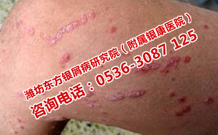 濰坊中醫(yī)院治療牛皮癬