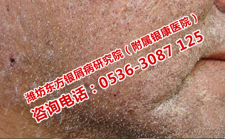 濰坊銀屑病醫院的理想的療法