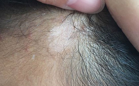治療白癜風的小竅門