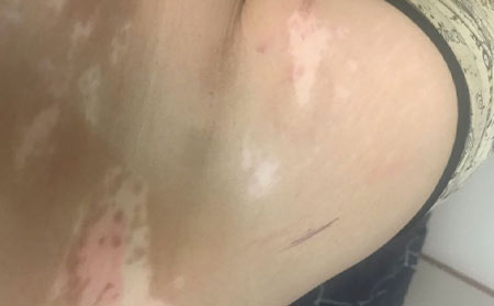 治療白癜風,白癜風的常見誤區