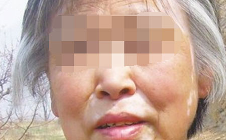 預防白癜風,預防白癜風方法