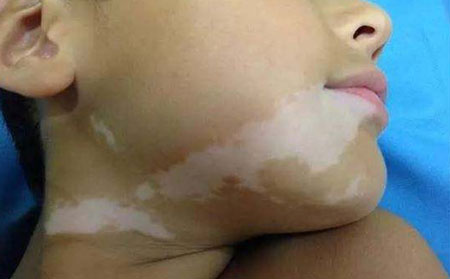 白癜風發病原因,白癜風病因,誘發白癜風病因