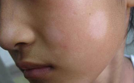 治療白癜風,白癜風治療效果,治療白癜風醫(yī)院