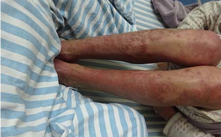 牛皮癬癥狀,春季牛皮癬癥狀