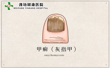 銀屑病指甲,銀屑病會(huì)得灰指甲嗎