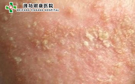 什么是特應(yīng)性皮炎與濕疹的區(qū)別是什么