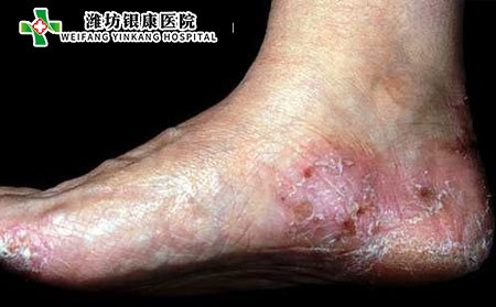 手足癬是什么?水皰型手足癬該如何治療?