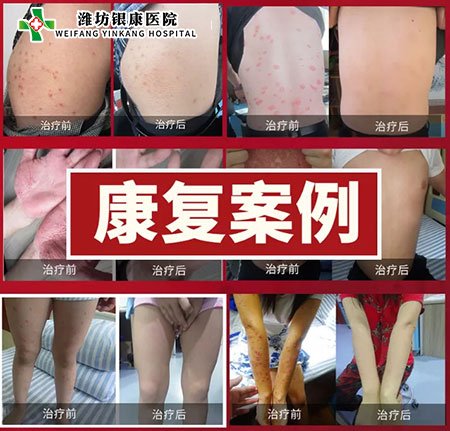 銀屑病皮膚病專(zhuān)家會(huì)診康復(fù)案例